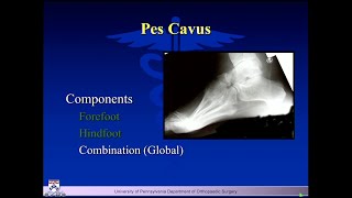 The Cavus Foot A Deformity That May Need Treatment amp What I Do amp When I Do It  Keith L Wapner MD [upl. by Alberik]