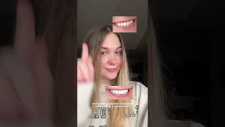 Lumineux teeth whitening strips before vs after linked in description teethwhitening [upl. by Madelena]