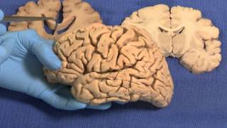 Limbic Neuroanatomy Video Lab  Brain Dissections [upl. by Wavell]