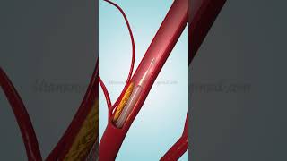 Coronary Angioplasty and Stent Insertion [upl. by Wing692]