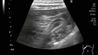 Ultrasound Video showing characteristic quotlayeringquot of Gall Bladder walls [upl. by Sillad]