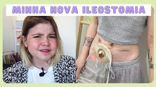 DIFERENÇAS DE ILEOSTOMIA PARA COLOSTOMIA [upl. by Weigle]