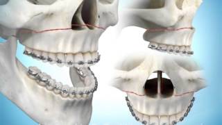 Maxillary Advancement Surgery [upl. by Nyleaj]