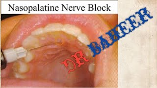 nasopalatine nerve block [upl. by Zolner]