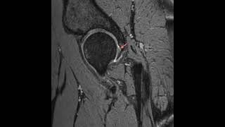 Tear of the posterior hip labrum [upl. by Renba]