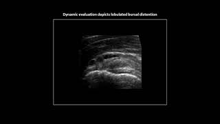 Lobulated subacromialsubdeltoid bursitis on shoulder ultrasound [upl. by Pesek]