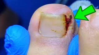 Patients Big Toenail Is Badly Infected Ingrown Toenail Removal ASMR Satisfying [upl. by Olram]