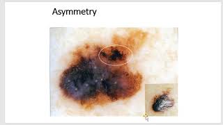 melanocytic lesions dermoscopy 2 dr yasmina el attar [upl. by Baskett]