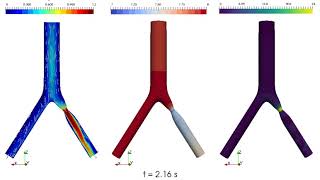 CFD Simulation of Idealised Iliac Bifurcation with Stenosis and Windkessel Outlet Boundary Condition [upl. by Retsim596]