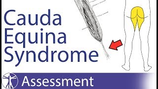 Cauda Equina Syndrome  Signs amp Symptoms [upl. by Scholem]