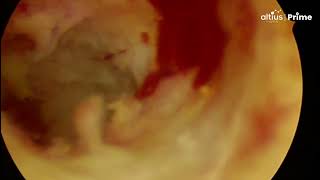 Hysteroscopic Adhesiolysis  Dr B Ramesh [upl. by Akinad]