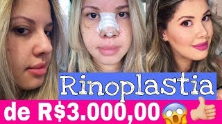 Rinoplastia de R300000 [upl. by Bebe]