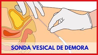 Sonda Vesical de Demora e os Cuidados de Enfermagem [upl. by Scevo]