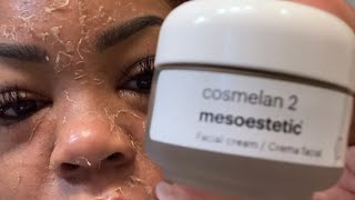 My unbelievable 30 day Cosmelan Peel journey [upl. by Aitsirk720]