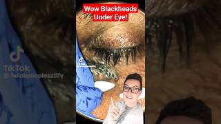 Crazy BLACKHEAD REMOVAL UNDER EYE  How Did This Happen shorts [upl. by Leahcimnaj71]