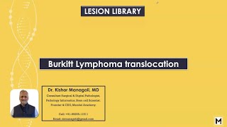 Pathology of Burkitt Lymphoma Translocation [upl. by Timothea]