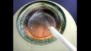 Explication Chirurgie refractive ICL Implant intraoculaire [upl. by Maddie]