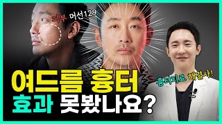 아프고 효과 없었던 여드름 흉터 치료 그만 ❌ 여드름흉터 없애는 법  큐어젯 쥬베룩 [upl. by Maudie]