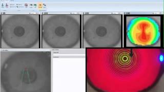 Corneal topography [upl. by Yma]