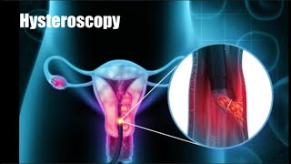 Hysteroscopy 3d animation procedure [upl. by Dnalyr]