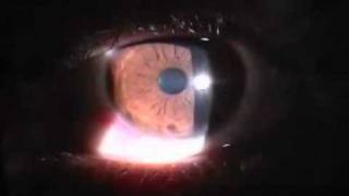 peripheral keratitis [upl. by Uos823]