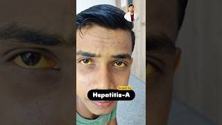 Hepatitis  Jaundice patient 😔  DrAnkit  health doctor shorts [upl. by Attenaej]