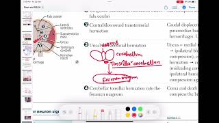 cerebellar tonsillar herniation neurology 151  First Aid USMLE Step 1 in UrduHindi [upl. by Dnalro]