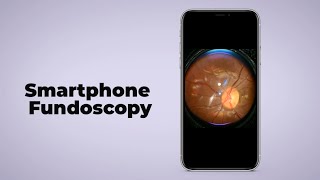 Smartphone Fundoscopy turn any smartphone into fundus camera [upl. by Aiceled]