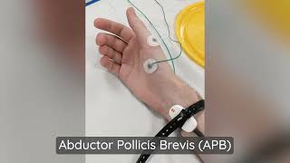 Abductor Pollicis Brevis APB Muscle Stimulation  Neurophysiology [upl. by Noelani]