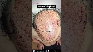 4500 Grafts Hair Transplant in one Day with weak Donor Area using Fusion Technique by Dr Suneet Soni [upl. by Ynetsed]