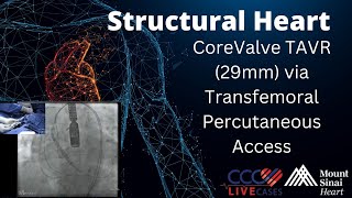 CoreValve TAVR 29mm via Transfemoral Percutaneous Access  February 2015 Structural Live Case [upl. by Ennovy]