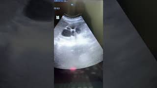 Severe Hydronephrosis with Renal Calculi ultrasound shortvideo shorts [upl. by Akla]