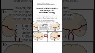 Treatment of intracerebral hemorrhage after thrombotic therapy [upl. by Airdnat]