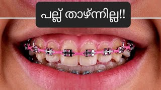 പല്ല് താഴ്ന്നില്ല pallil kambi idunnath malayalam braces pallil kambi  kambi  dental palludr [upl. by Bainbrudge]