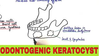 Odontogenic Keratocyst  Clinical Radiographic and Histopathologic Features [upl. by Atinit315]