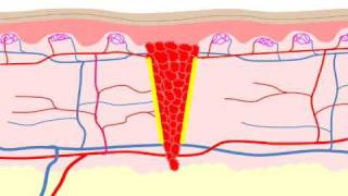 Wound Healing [upl. by Adlesirc]