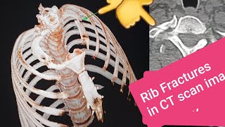 fracture FRACTURED RIB ON CT SCAN [upl. by Htederem]