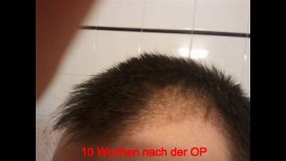 Haartransplantation Türkei post OP Bilder [upl. by Eitac]