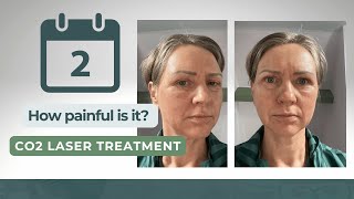 How Painful Is Day 2 After Co2 Laser Treatment [upl. by Yedarb26]