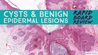 Rapid Board Review Cysts amp Benign Epidermal Lesions Dermpath Dermatology Pathology [upl. by Lizette]