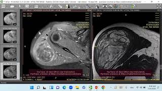 Liposarcoma [upl. by Aneev]