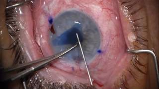 Complex DMEK  Graft Unfolding in Vitrectomized Eyes  Cannula Technique [upl. by Tarsus]