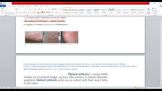 Plab 1 Lectures Dermatology Part 4 Guttate PsoriasisUrticaria [upl. by Slohcin]