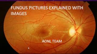 Fundus images explained by an ophthalmologist [upl. by Drusus486]