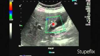 Gallbladder polyp color Doppler ultrasound [upl. by Nirhtak]