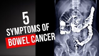 5 warning signs of Bowel Cancer you should NEVER ignore [upl. by Atimed]