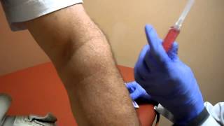 Patient Case Review 52 yoa male Lateral Epicondylitis Tennis Elbow Testimonial Prolotherapy [upl. by Burd519]