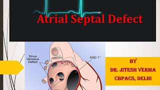 ASD  Atrial Septal Defect  Congenital Heart Diseases [upl. by Zoba]