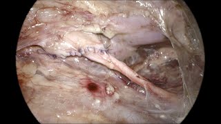 Retroperitoneoscopic pyeloplasty OR Setup port position and retroperitoneal access [upl. by Zerdna]