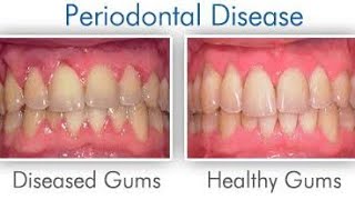 quotSaveYourSmile Understanding Periodontitis and Howto Prevent Itquotgumdisease oralhealthdentist [upl. by Nally977]